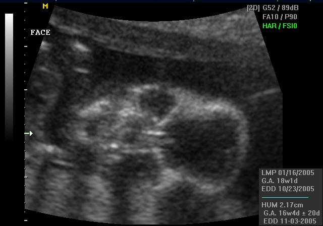 Ultrasound — Kennedy's face