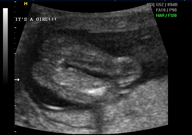 Ultrasound — It's a girl